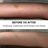 Lumara Illuminate Green – High-Performance 525 nm LED Therapy Panel